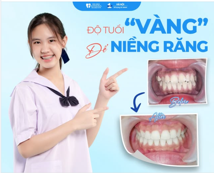 Độ tuổi “vàng” để niềng răng là khi nào?