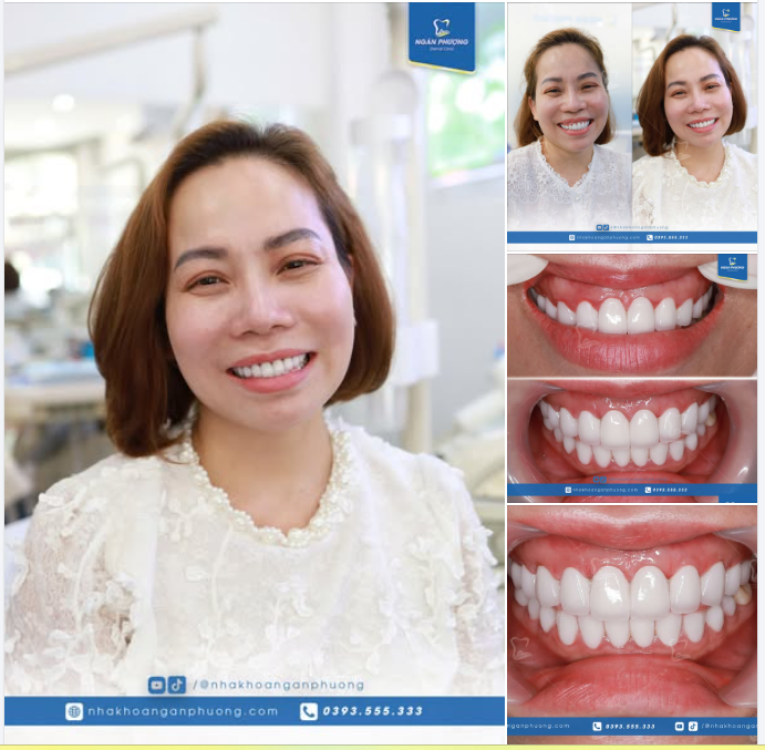 Lợi khỏe đẹp, nụ cười tự tin