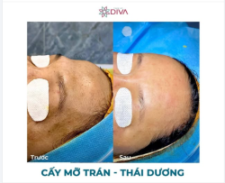 CẤY MỠ TRÁN - PHƯƠNG PHÁP ĐIỀU CHỈNH HIỆU QUẢ CHO KHUYẾT ĐIỂM VÙNG TRÁN
