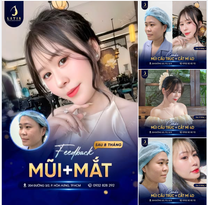 FEEDBACK COMBO NÂNG MŨI + CẮT MÍ - ĐẸP TOÀN DIỆN, TIẾT KIỆM THỜI GIAN