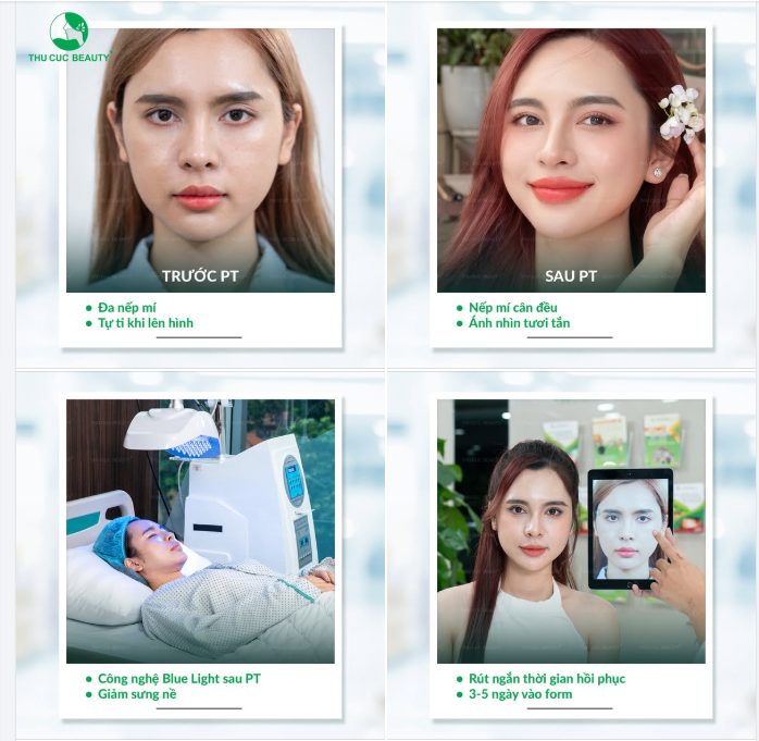 Cắt mí nhanh vào form - Kịp đẹp đón Đại Lễ