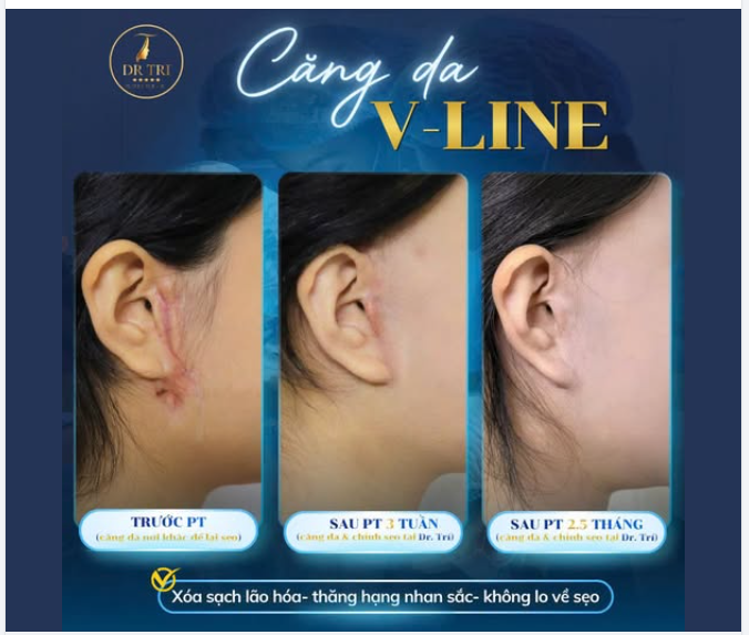 CĂNG DA V-LINE: ĐỈNH CAO KỸ THUẬT "GIẤU SẸO" TẠI DR. TRÍ