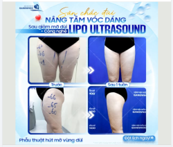 SĂN CHẮC ĐÙI – NÂNG TẦM VÓC DÁNG