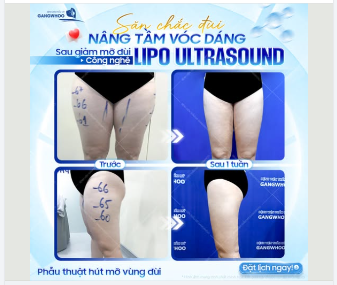 SĂN CHẮC ĐÙI – NÂNG TẦM VÓC DÁNG