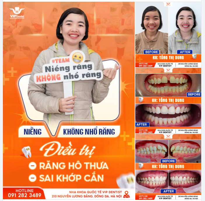 COMBO NGẠI NIỀNG ĐÃ ĐƯỢC GIẢI QUYẾT SAU KHI GẶP "CHÂN ÁI " VIP DENTIST !