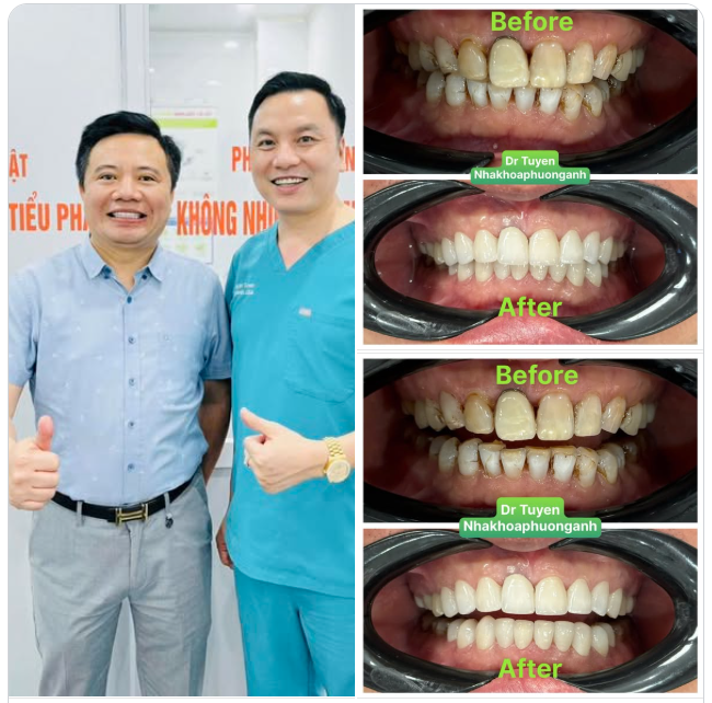 Combor: IMPLANT tức thì VENER sứ toàn hàm.