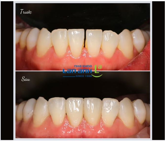 Veneer sứ đóng kẽ răng cửa thưa – giải pháp thẩm mỹ lâu dài