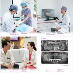 TÁI KHÁM ĐỊNH KỲ là thói quen quan trọng được bác sĩ khuyến cáo sau khi trồng răng Implant.