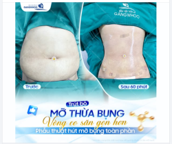 CẢI THIỆN VÙNG MỠ BỤNG – NHẸ NHÀNG LÀM MỚI VÒNG EO