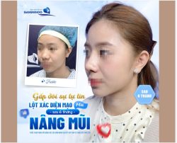 GẤP ĐÔI SỰ TỰ TIN LỘT XÁC NGOẠN MỤC SAU 6 THÁNG NÂNG MŨI