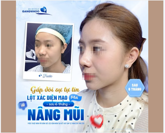 GẤP ĐÔI SỰ TỰ TIN LỘT XÁC NGOẠN MỤC SAU 6 THÁNG NÂNG MŨI