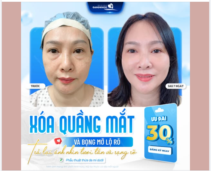 XÓA QUẦNG MẮT  BỌNG MỠ – TRẢ LẠI ÁNH NHÌN TƯƠI TẮN, RẠNG RỠ