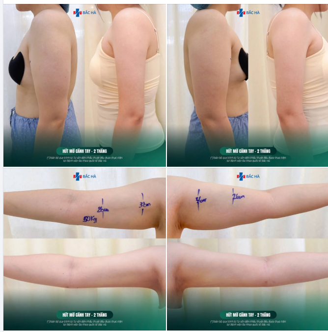 NHÌN CỨ NGHĨ TAY DÀI RA… NHƯNG KHÔNG, CHỈ LÀ GỌN ĐI THÔI