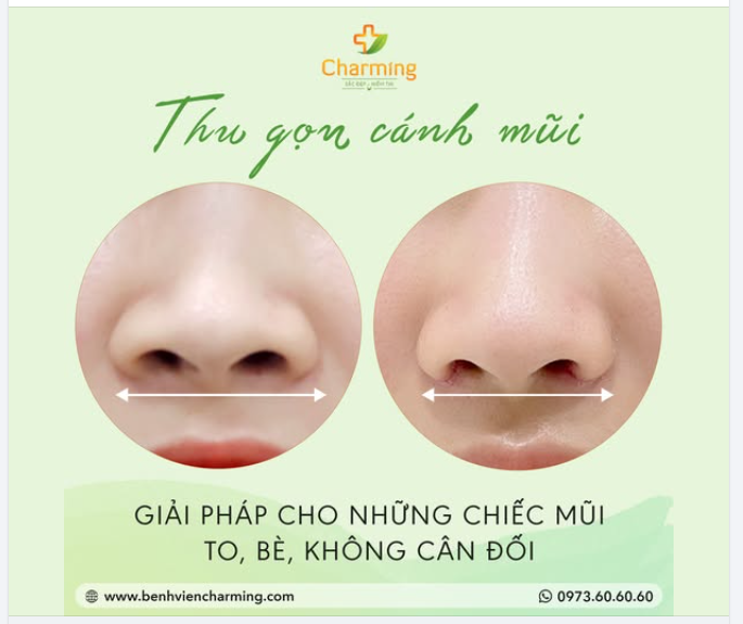 CẮT CÁNH MŨI: GIẢI PHÁP "TỈ LỆ VÀNG" CHO TỪNG DÁNG MŨI