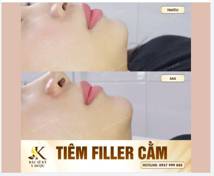 CASE TIÊM FILLER CẰM – NHẸ NHÀNG NHƯNG LÊN FORM RÕ RỆT