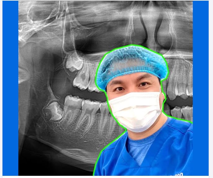 Khi nào cần chụp x quang răng khôn?