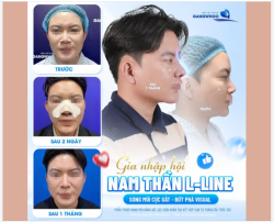 GIA NHẬP HỘI NAM THẦN L-LINE SAU 1 THÁNG NÂNG MŨI