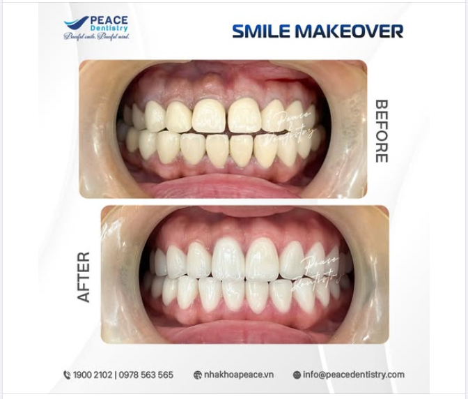 24 RĂNG SỨ ZIRCONIA CAO CẤP - Phục hình toàn diện, bảo tồn răng gốc tối đa