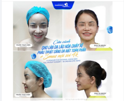 “Trước đây mỗi lần soi gương… tôi chỉ thấy sự mệt mỏi.” Da chùng xuống, nếp nhăn hằn sâu… Gương mặt không còn là chính mình của vài năm trước.