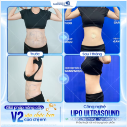 KHI VÒNG 2 KHÔNG CÒN LÀ "NỖI LO"