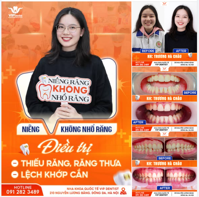 "NIỀNG RĂNG XONG THẤY XINH HƠN NHIỀU" - là chia sẻ của rất nhiều bạn gái khi tháo mắc cài tại Vip Dentist