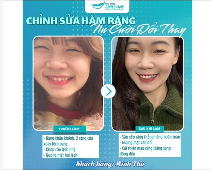 CHỈNH NHA - THAY ĐỔI NHỎ ẢNH HƯỞNG TOÀN BỘ NỤ CƯỜI