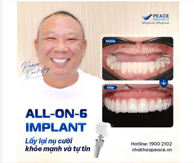ĐIỀU GÌ SẼ KHÔNG THAY ĐỔI SAU KHI TRỒNG RĂNG IMPLANT?