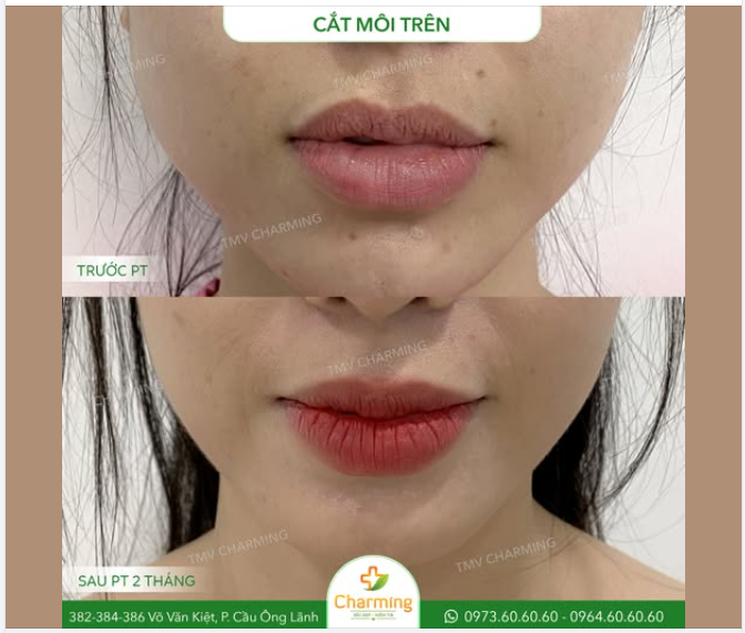 KHẮC PHỤC MÔI HỞ SAU CẮT MÔI – LẤY LẠI DÁNG MÔI TỰ NHIÊN