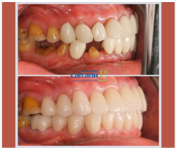 Làm răng sứ không chỉ là cải thiện màu sắc hay hình dáng, mà còn là sự cân đối với tổng thể nụ cười.