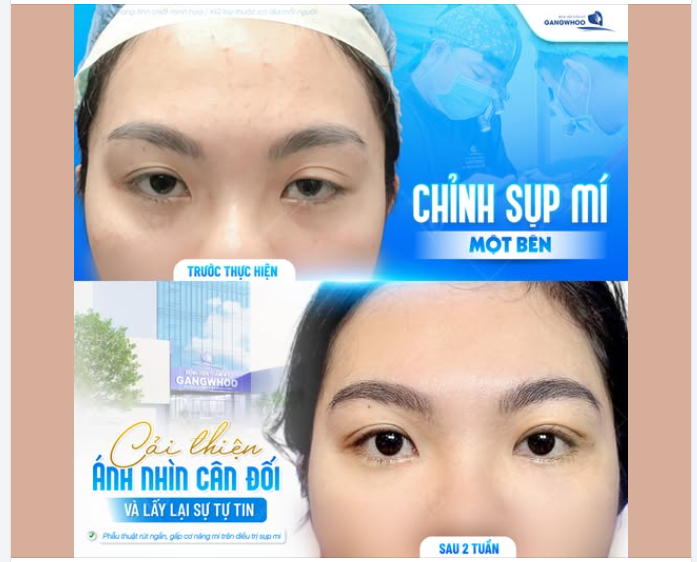CHỈNH SỤP MÍ MỘT BÊN – CÂN ĐỐI ÁNH NHÌN, LẤY LẠI SỰ TỰ TIN