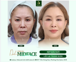 Căng da Midface - “Chìa khóa hack tuổi” cực đỉnh!!