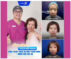 GIỮ NÉT XƯA BỎ ĐI NẾP NHĂN SAU 1 LẦN THỰC HIỆN