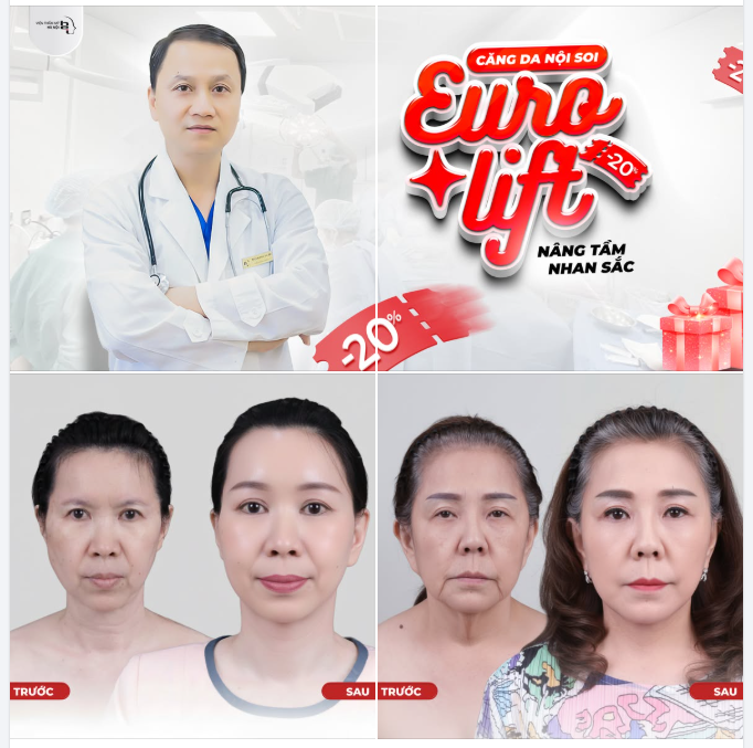 CĂNG DA EURO LIFT  LẤY LẠI 10 NĂM THANH XUÂN – ĐẸP TỰ NHIÊN, KHÔNG DẤU VẾT