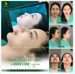 NÂNG MŨI CẤU TRÚC + ĐỘN CẰM SURGIFORM COMBO ĐẸP TOÀN DIỆN, BỀN DÀI LÂU!!