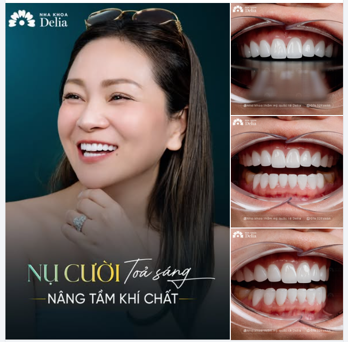 "Chọn làm răng sứ chính là khoản đầu tư cho bản thân mình thấy lời nhất"