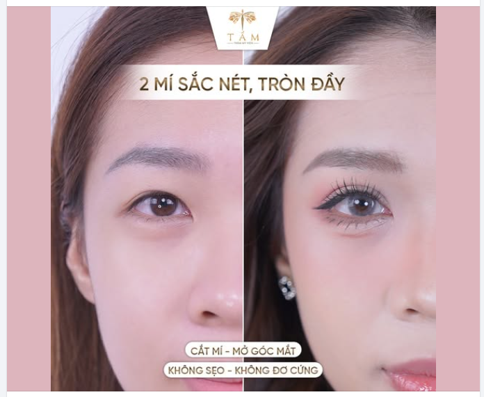 CẮT MÍ - MỞ GÓC MẮT KHÔNG SẸO, KHÔNG ĐƠ CỨNG