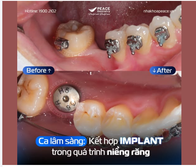 Nhiều khách hàng thắc mắc: Mất răng có chỉnh nha được không?