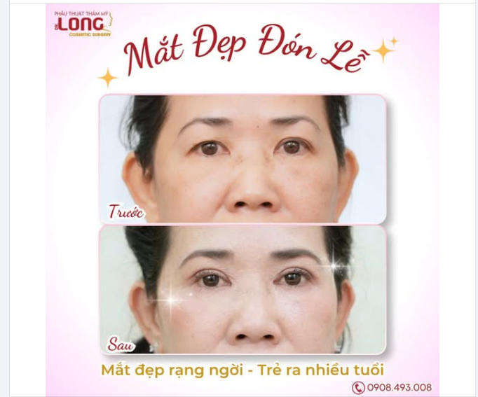 MẮT sụp mí, da dư nhiều ​​​​​​​Nguyên nhân làm diện mạo già hơn nhiều tuổi.