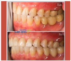 Khi mão sứ cũ bị hở cổ, có thể gây ê buốt, dễ giắt thức ăn và khó vệ sinh hơn.