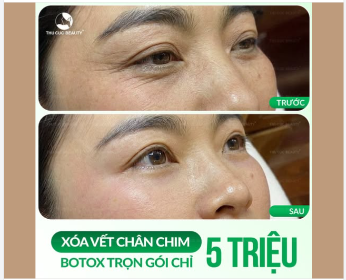 XÓA VẾT CHÂN CHIM CHỈ 5 TRIỆU