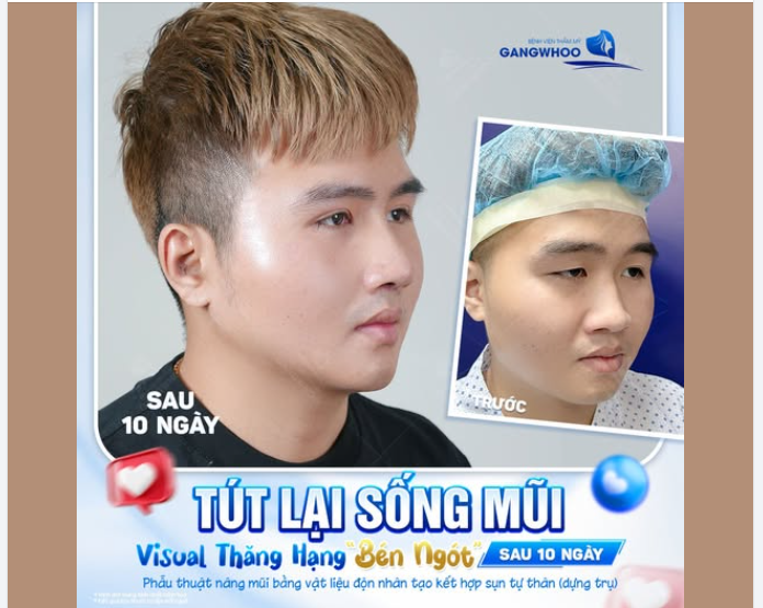 TÚT LẠI SỐNG MŨI