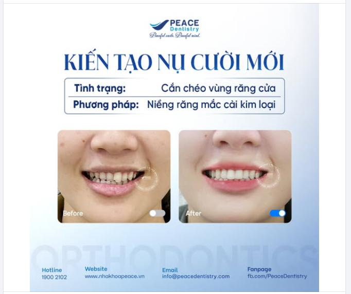 Khớp cắn chéo gây lệch mặt, các đường nét kém hài hòa. Đây là một trong những ca điều trị khá phức tạp đòi hỏi chẩn đoán đúng và kỹ thuật chính xác.