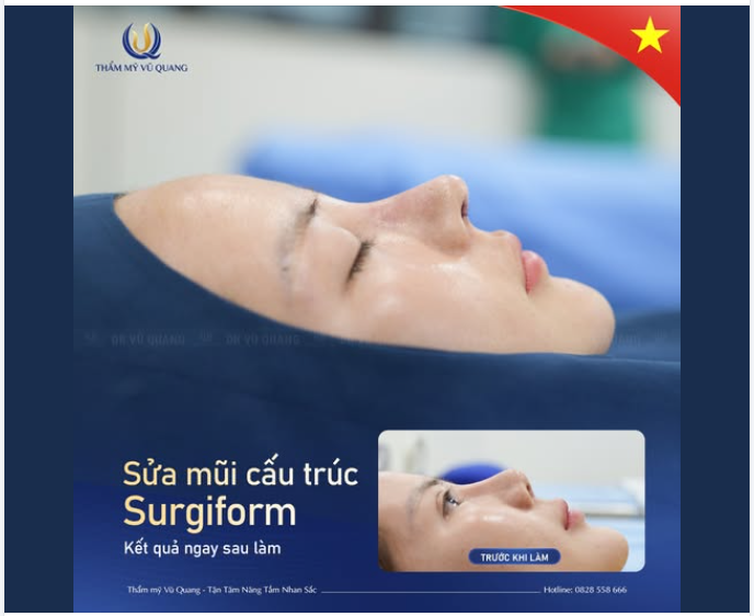 SỬA MŨI CẤU TRÚC SOFTLINE – GIẢI CỨU MŨI HỎNG