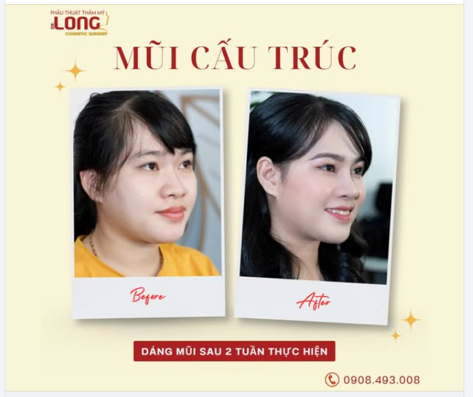 SAU 2 TUẦN kể từ ngày nâng mũi, điều gì sẽ đến ?