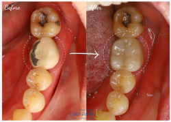 Răng sứ làm kỹ thuật cũ, dễ bị bể mẻ mà hay nhồi nhét thức ăn lắm ạ, nhìn hình so sánh răng sứ làm tại nha khoa Lan Anh là thấy khác biệt ạ