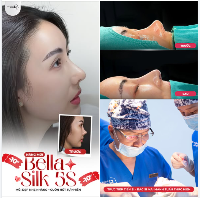 SỬA MŨI HỎNG, LẤY LẠI TỰ TIN – CHỈ 30 PHÚT VỚI BELLA SILK 5S