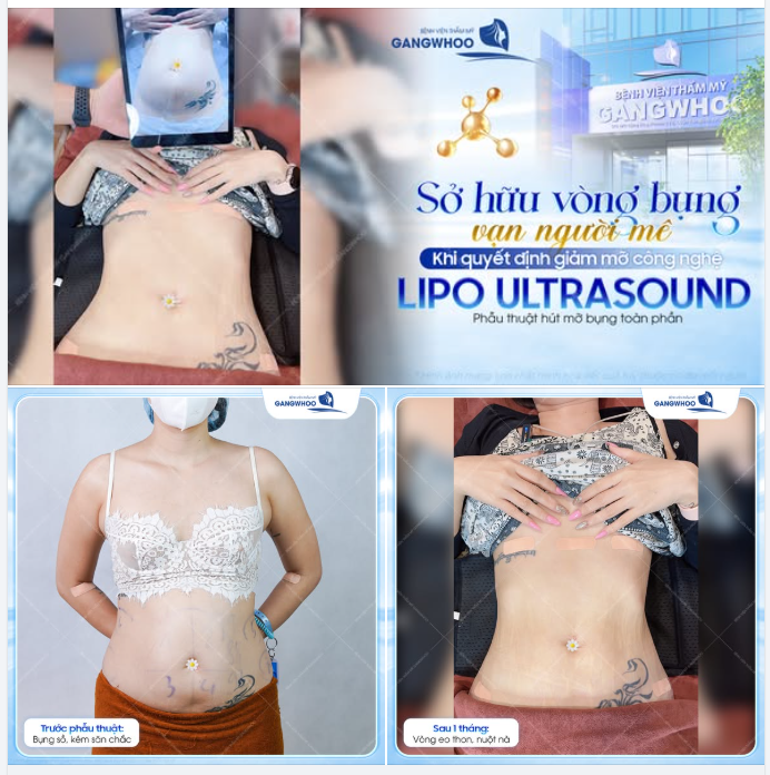 CHINH PHỤC VÒNG EO THON GỌN – KHI SỰ THAY ĐỔI BẮT ĐẦU TỪ QUYẾT ĐỊNH ĐÚNG ĐẮN