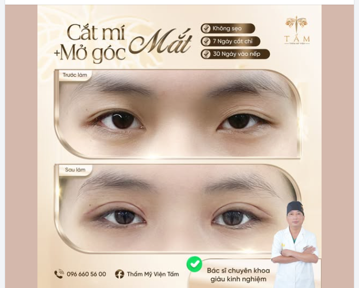 Đừng TỰ TI về đôi mắt NHƯỢC CƠ nữa!