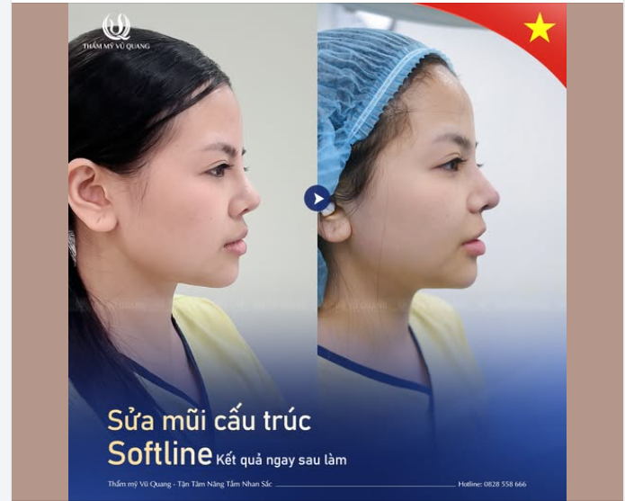 Thêm một case sửa mũi lệch – hếch – thô to để chị em tham khảo!
