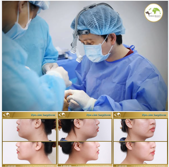 Độn cằm không chỉ đơn thuần là làm dài cằm mà là kỹ thuật tạo hình giúp khắc phục những khiếm khuyết bẩm sinh của cằm đồng thời cân đối tổng thể gương mặt mang lại vẻ đẹp thanh thoát và hài hòa hơn.